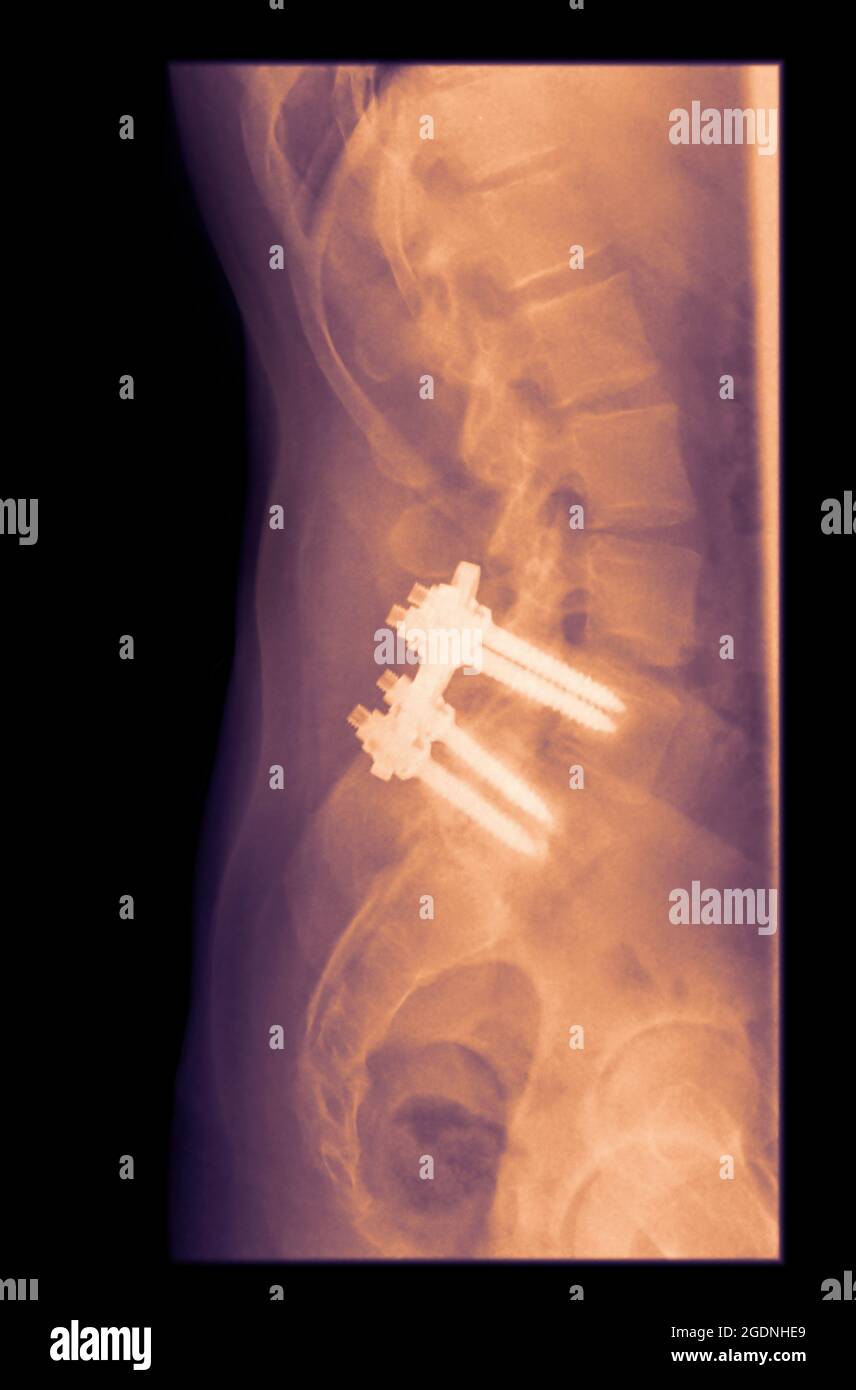 Raggi X di un maschio di 31 anni con viti in L4 e L5 per alleviare il dolore alla schiena Foto Stock