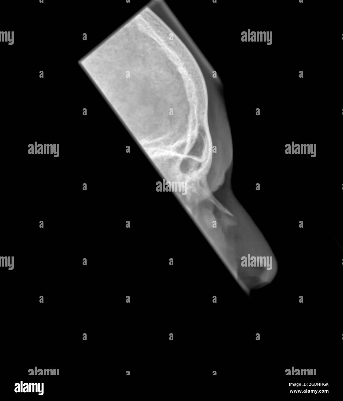 Raggi X del cranio e del naso di un maschio di 14 anni che mostra una frattura sull'osso del naso Foto Stock