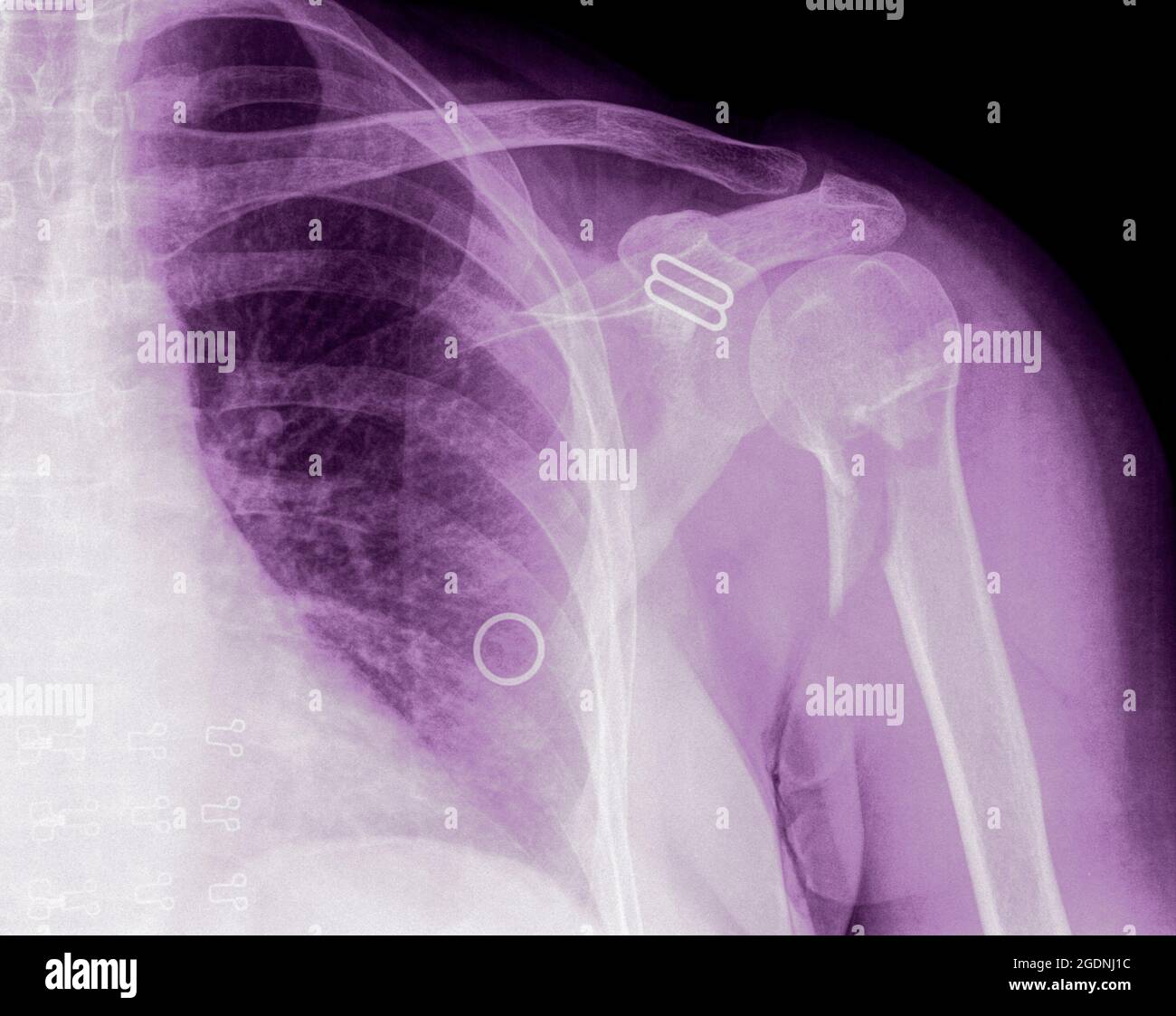 Frattura dell'osso dell'omero dopo un intervento chirurgico di 64 anni femmina Foto Stock