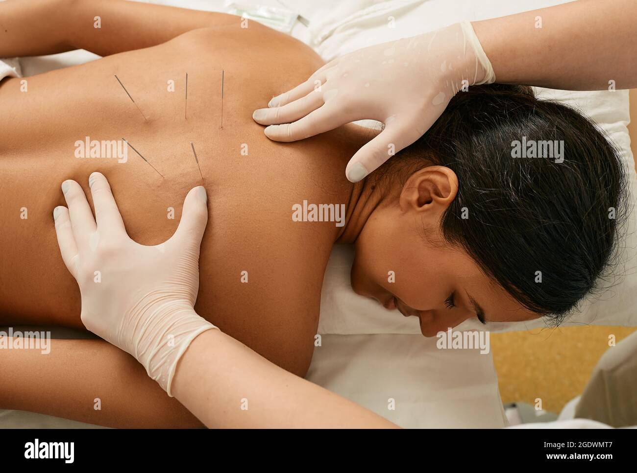 Agopuntura per una schiena di una donna asiatica in una clinica medica tradizionale cinese. Vista dall'alto Foto Stock
