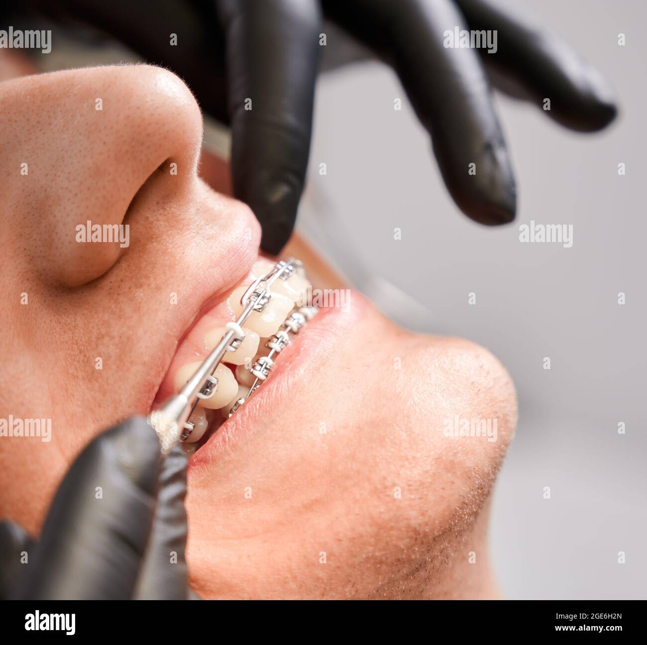 Primo piano delle mani ortodontiste in guanti sterili che mettono la fascia elastica di gomma sulle staffe del paziente in clinica dentale. Concetto di stomatologia, odontoiatria A. Foto Stock