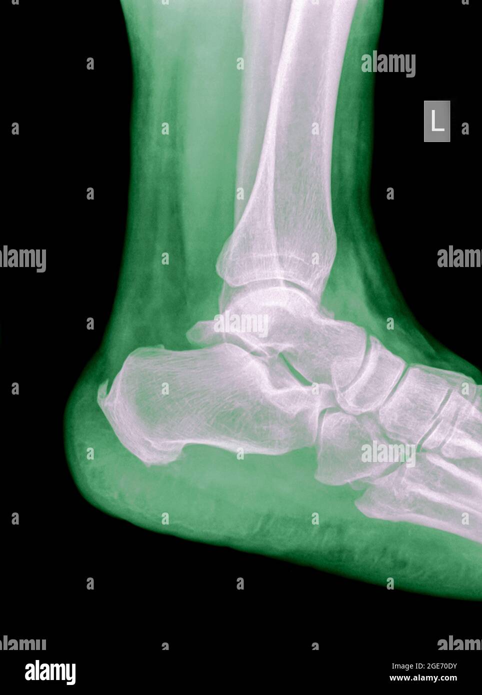 Radiografia di un maschio di 50 anni di caviglia con tibia distale fratturata. Vista laterale Foto Stock