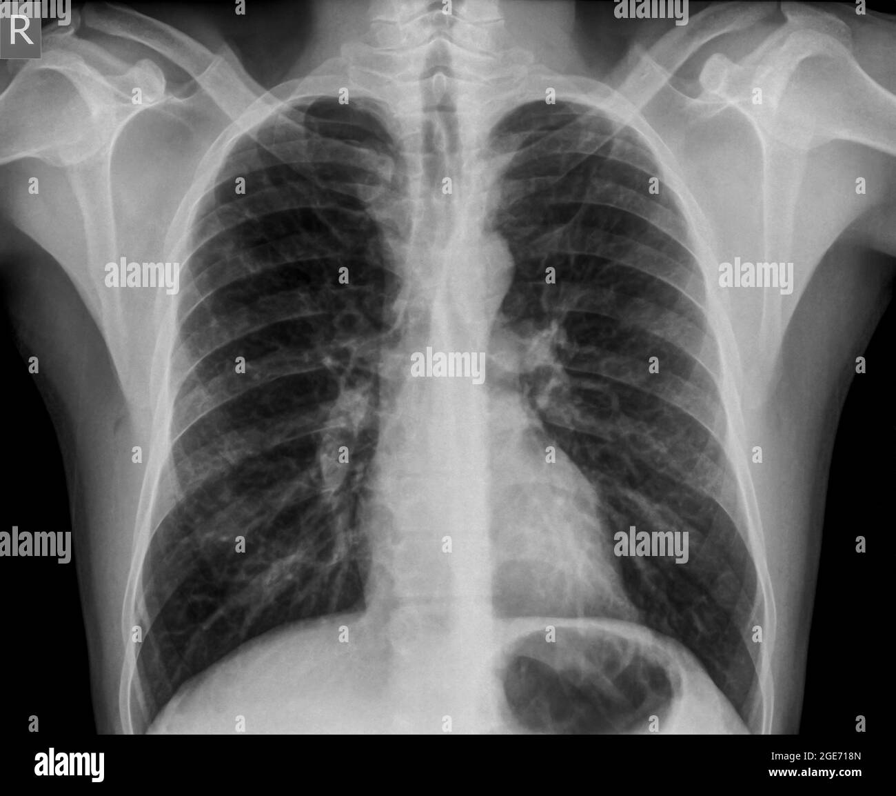 Radiografia normale del torace sano di un maschio di 36 anni. Vista frontale Foto Stock