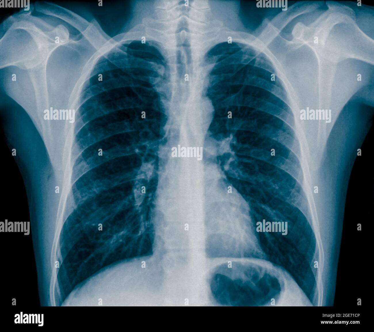 Radiografia normale del torace sano di un maschio di 36 anni. Vista frontale Foto Stock