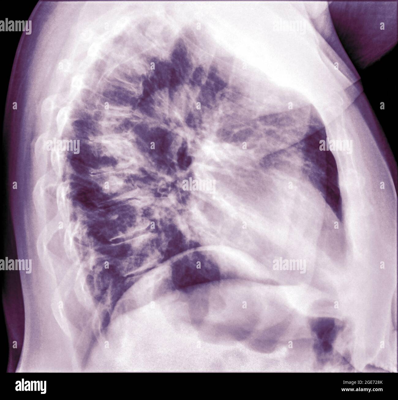 Radiografia toracica di una paziente di 57 anni con segni di polmonite nel lobo inferiore destro (RLL) della vista laterale del polmone Foto Stock