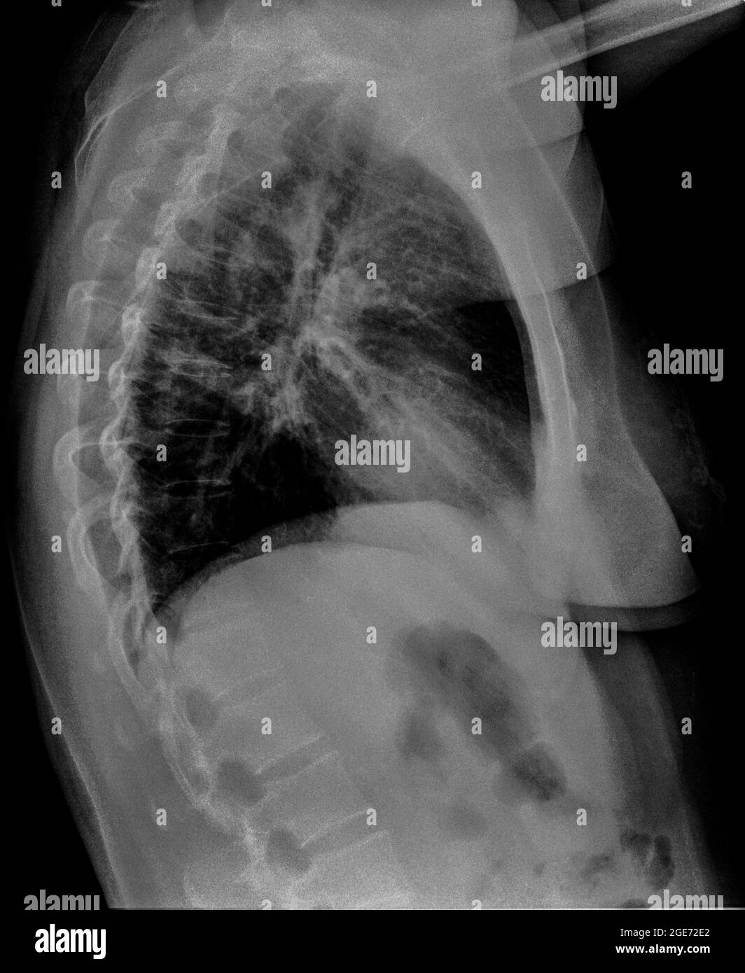 Radiografia toracica di una donna matura con polmonite. Vista laterale Foto Stock