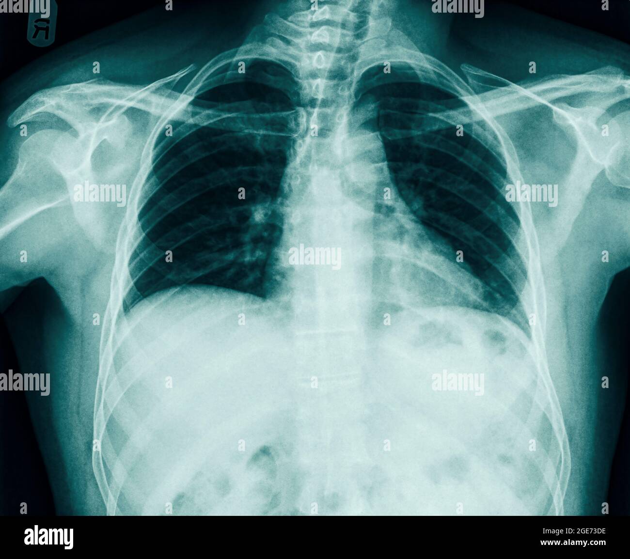 Frattura del numero 10 nervatura può essere visto in una radiografia del torace di un 36 enne maschio. vista frontale Foto Stock