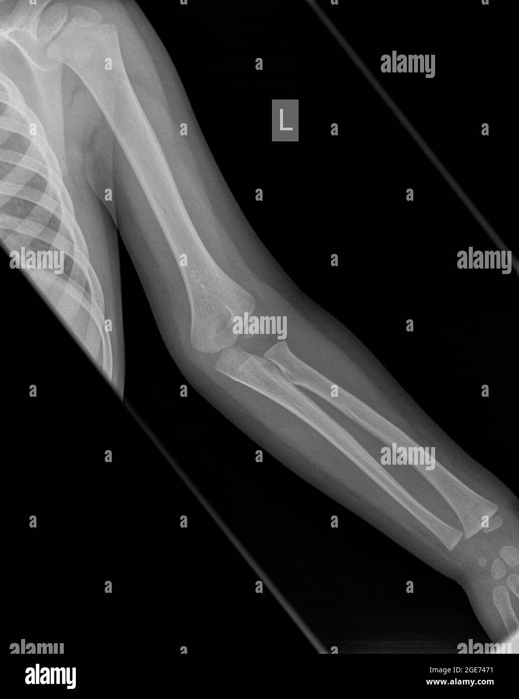 Raggi X di un avambraccio umano con cuscinetto di grasso segni e un Supracondylar omero frattura al braccio sinistro di un bambino di 3 anni bambino maschio Foto Stock