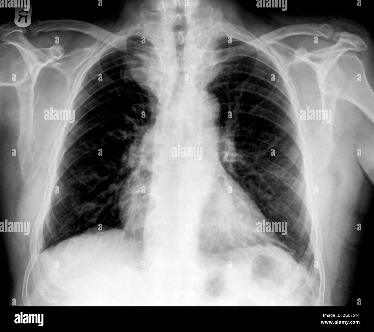 Radiografia normale del torace sano di un maschio di 63 anni. Vista frontale Foto Stock