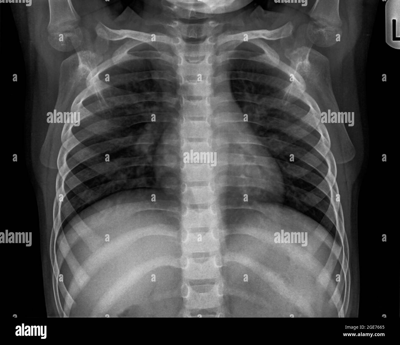 Radiografia toracica di un bambino di 3 anni. Vista frontale con polmonite in LLL (lobo inferiore sinistro) Foto Stock