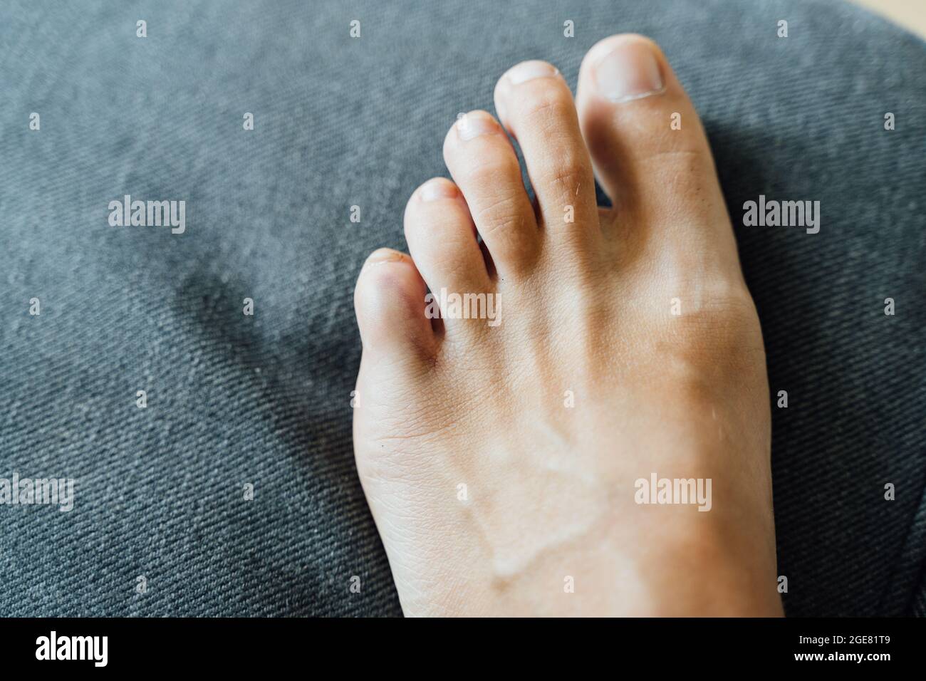 Lesioni alle dita dei piedi. Dolore e lividi al dito del piede dopo un  incidente a casa. Frattura di Falange. Unghie a piedi nudi sano Foto stock  - Alamy