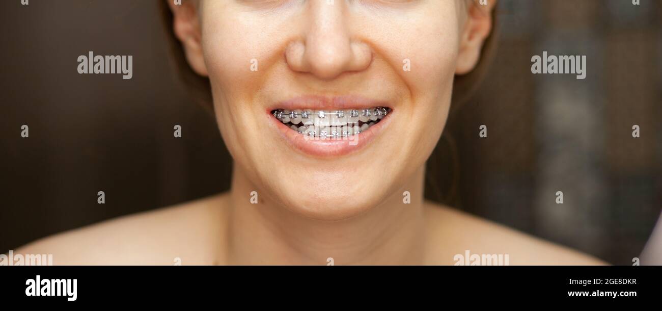 Il sorriso di una giovane e bella ragazza con bretelle sui denti bianchi. Raddrizzatura dei denti storti con l'ausilio di un sistema a staffa. Malocclusione Foto Stock