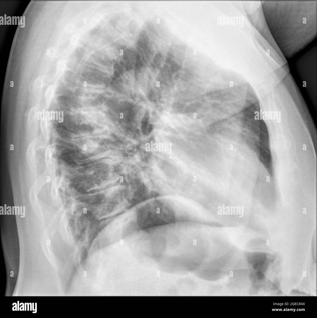 Radiografia toracica di una paziente di 57 anni con segni di polmonite nel lobo inferiore destro (RLL) della vista laterale del polmone Foto Stock