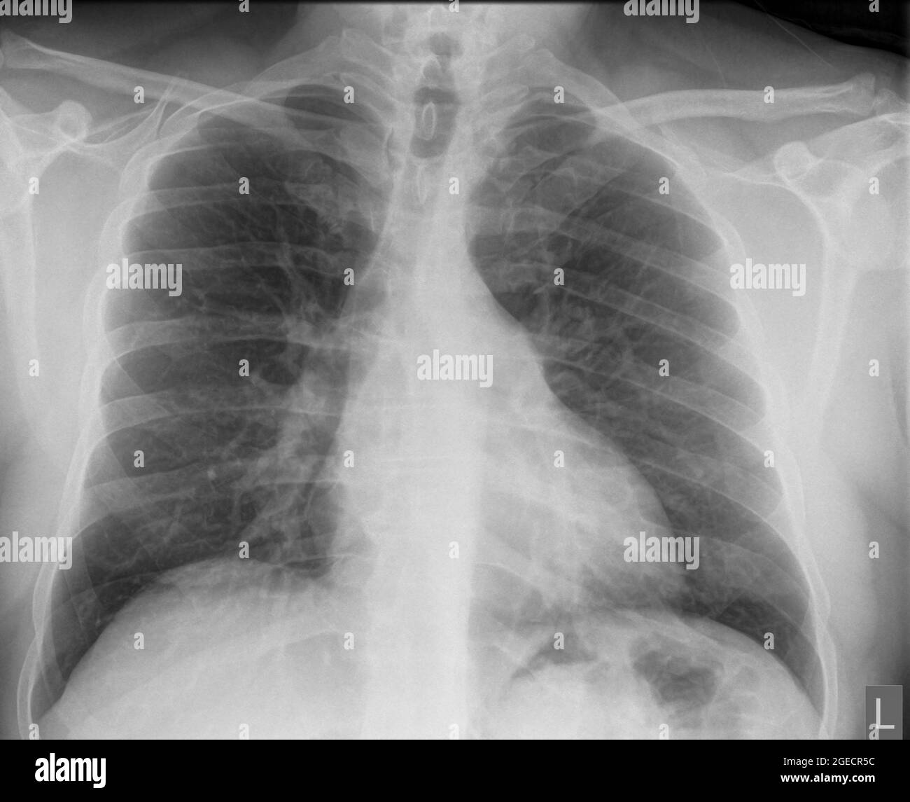 Radiografia normale del torace sano di un maschio di 46 anni. Vista frontale Foto Stock