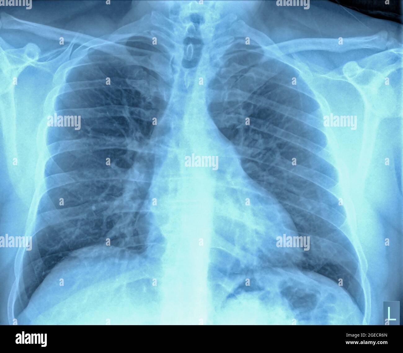 Radiografia normale del torace sano di un maschio di 46 anni. Vista frontale Foto Stock