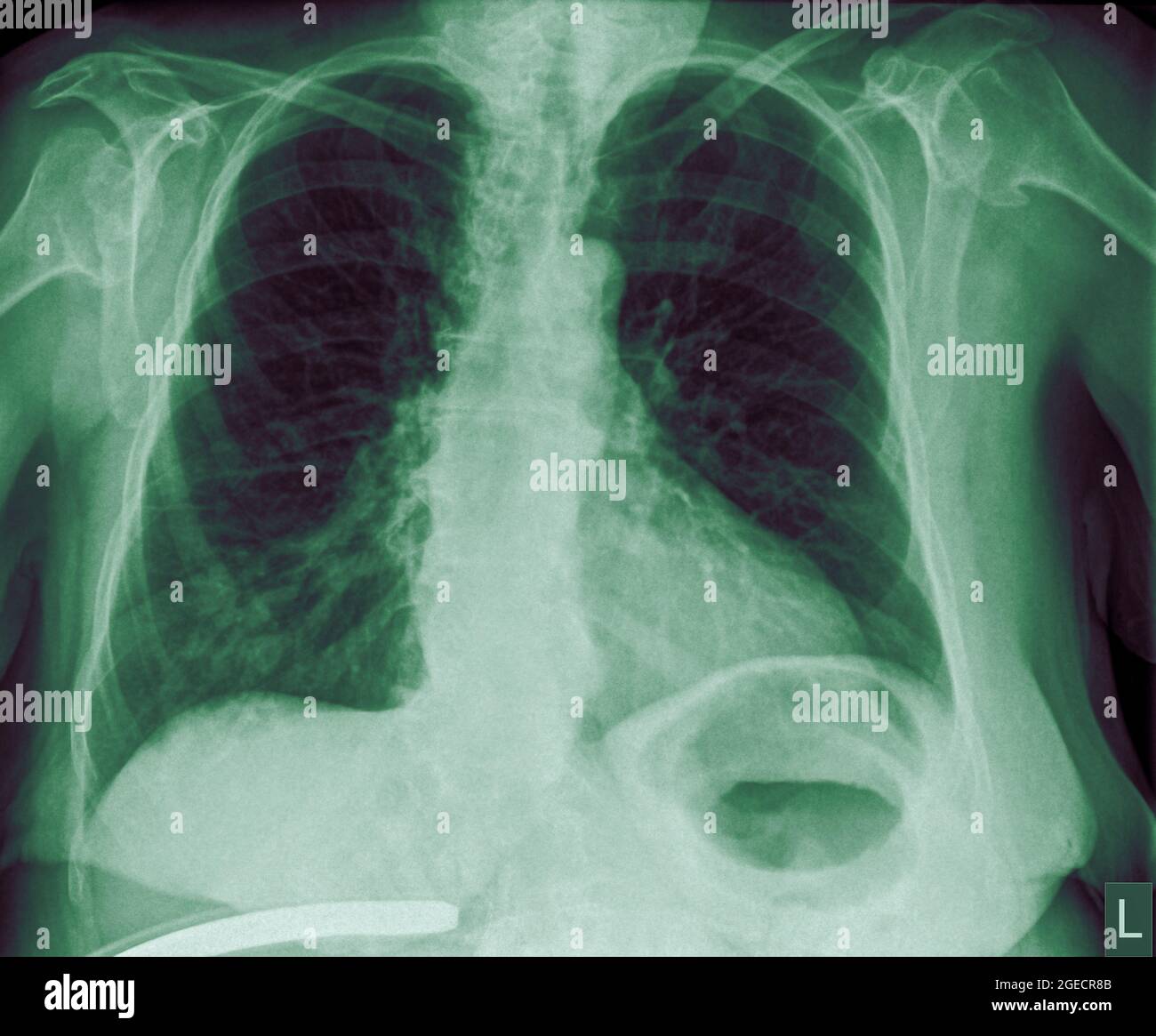 Radiografia toracica di una paziente di 57 anni con segni di polmonite nel lobo inferiore destro (RLL) della vista frontale del polmone Foto Stock