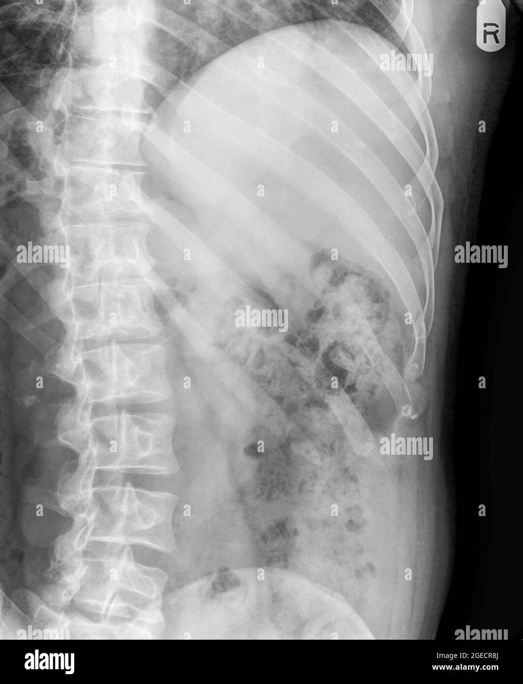 Frattura del numero 10 nervatura può essere visto in una radiografia del torace di un 36 enne maschio. vista frontale Foto Stock