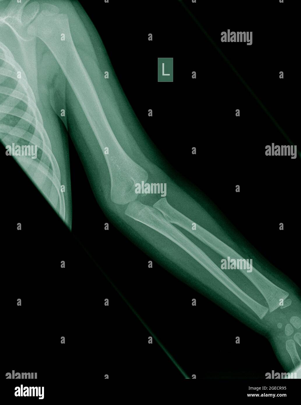 Raggi X di un avambraccio umano con cuscinetto di grasso segni e un Supracondylar omero frattura al braccio sinistro di un bambino di 3 anni bambino maschio Foto Stock