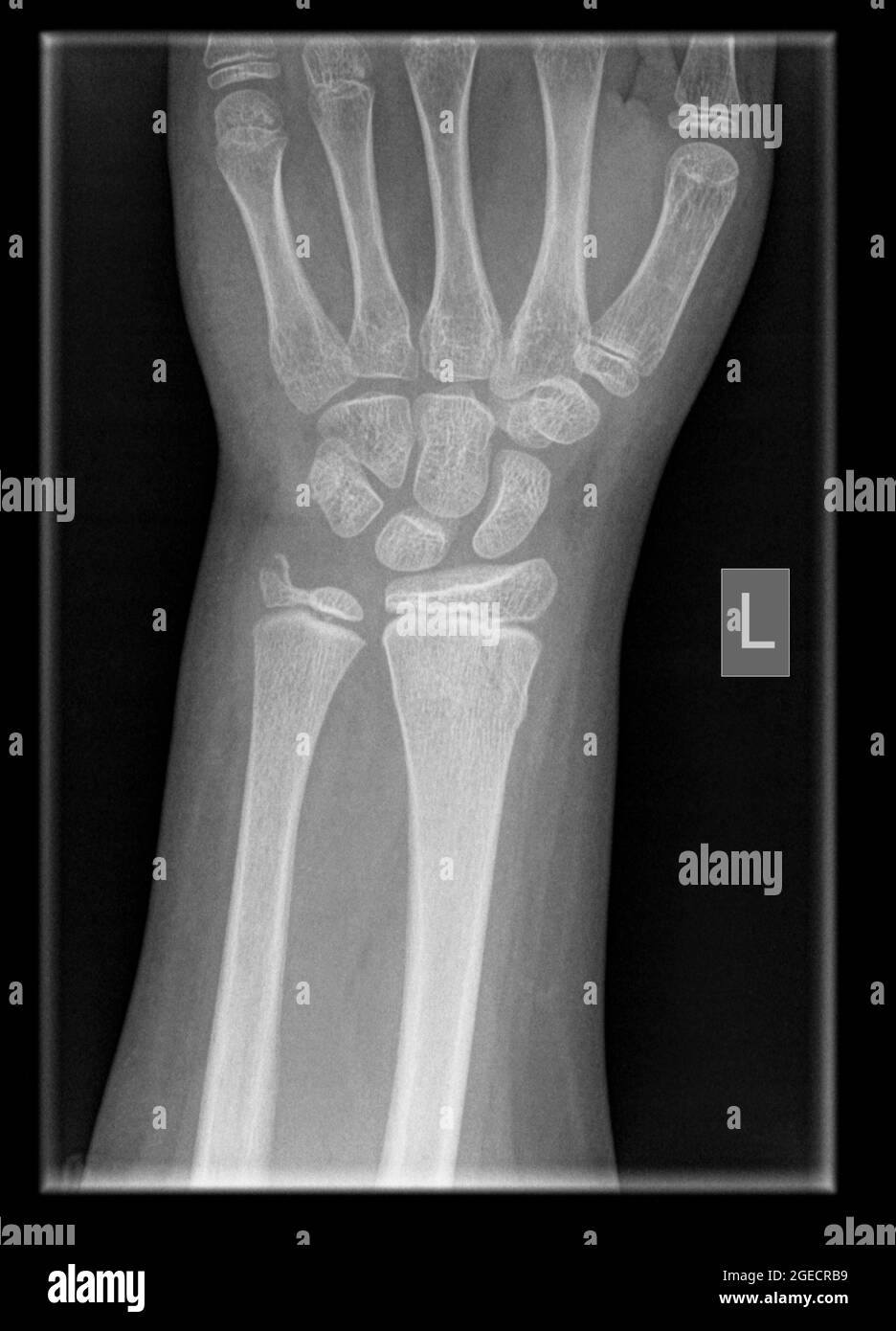 Polso di un paziente maschio di 9 anni con fratture di raggio distale e ulna Foto Stock