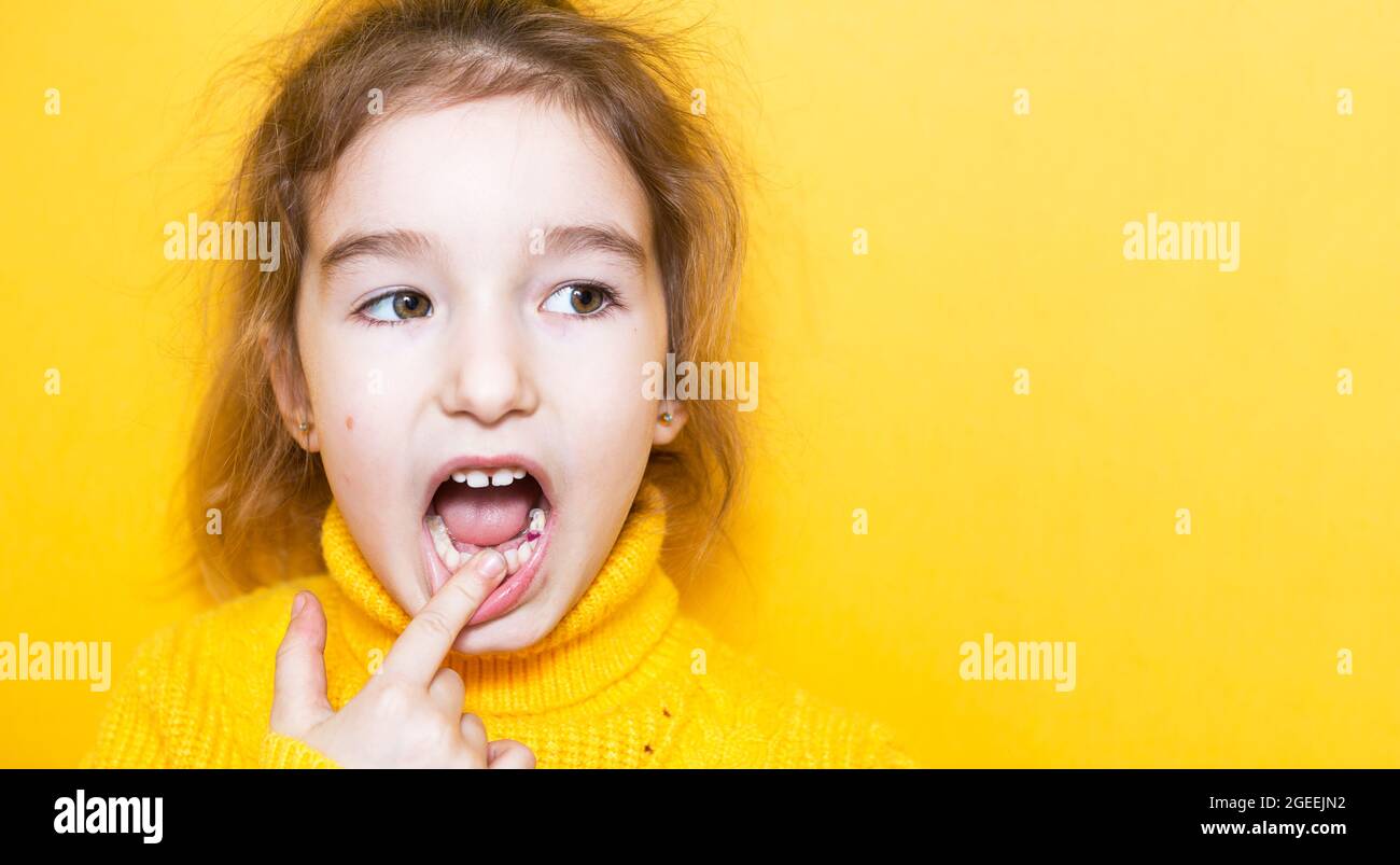 Ripieno viola colorato sul dente da masticare del latte della ragazza. Odontoiatria pediatrica, trattamento ed esame. Un bambino con bocca aperta mostra un dente in c Foto Stock