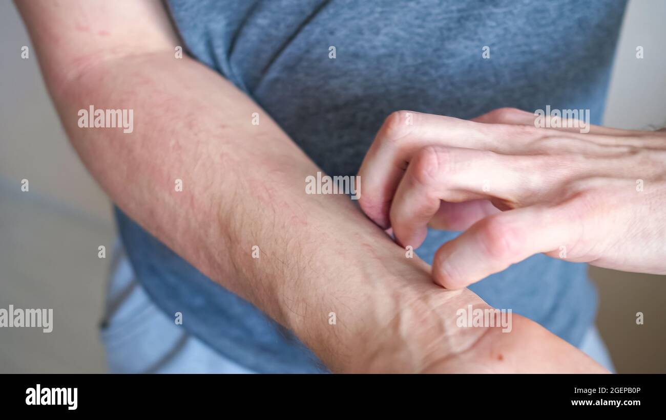 Nan graffia l'avambraccio a mano con prurito cutaneo Foto Stock