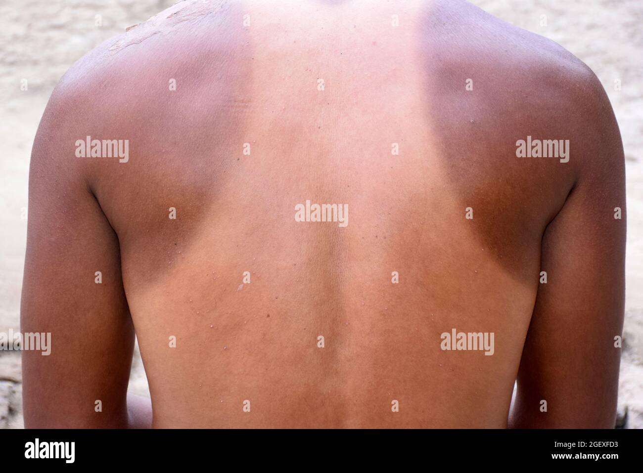 Spalle e collo particolarmente soleggiati, parte del corpo tra l'articolazione laterale superiore del braccio umano e il collo, reazione a lesioni o infettanti Foto Stock