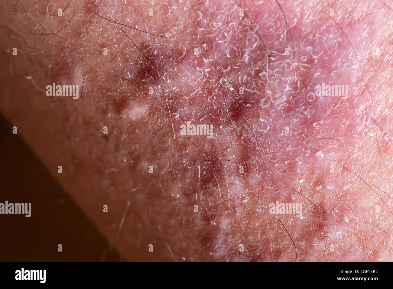 Piano di lichene su pelle gamba primo piano. Malattia dermatologica sotto forma di macchie rosse, eruzioni cutanee e prurito della superficie cutanea. Foto Stock