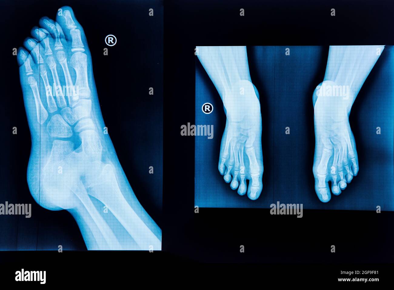 Raggi X dei piedi umani. Radiografia normale del piede, diagnostica medica, traumatologia e ortopedia Foto Stock