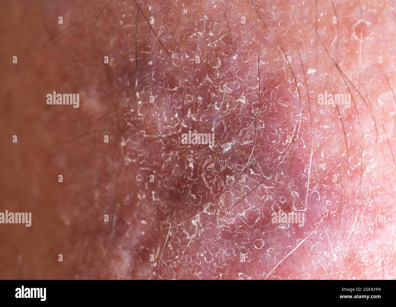 Primo piano della pelle irregolare con macchie e epidermide squamoso, dermatologia e malattie della pelle. Foto Stock