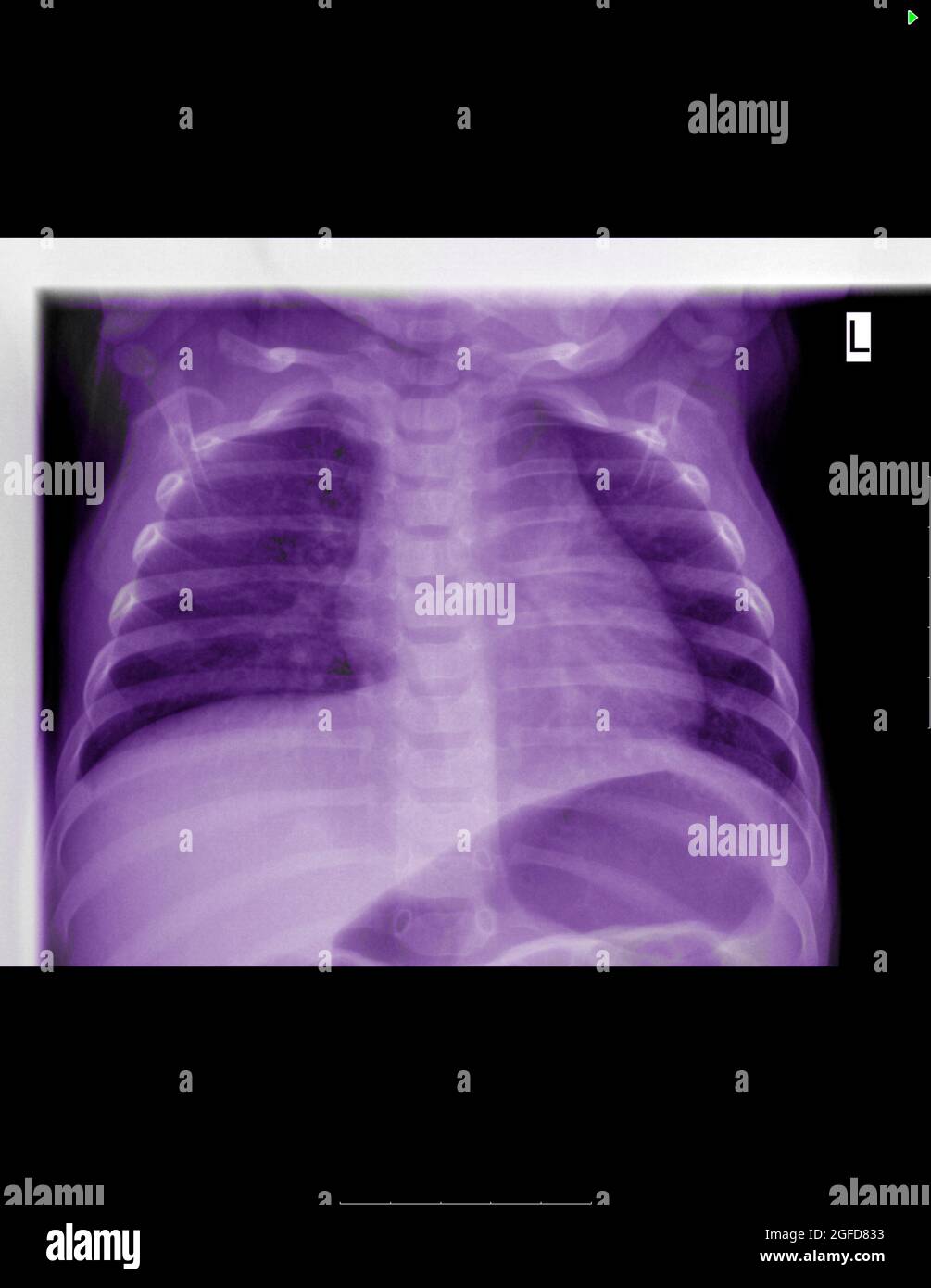 Radiografia di un bambino di 6 mesi affetto da gastroenterite virale e leucopenia Foto Stock