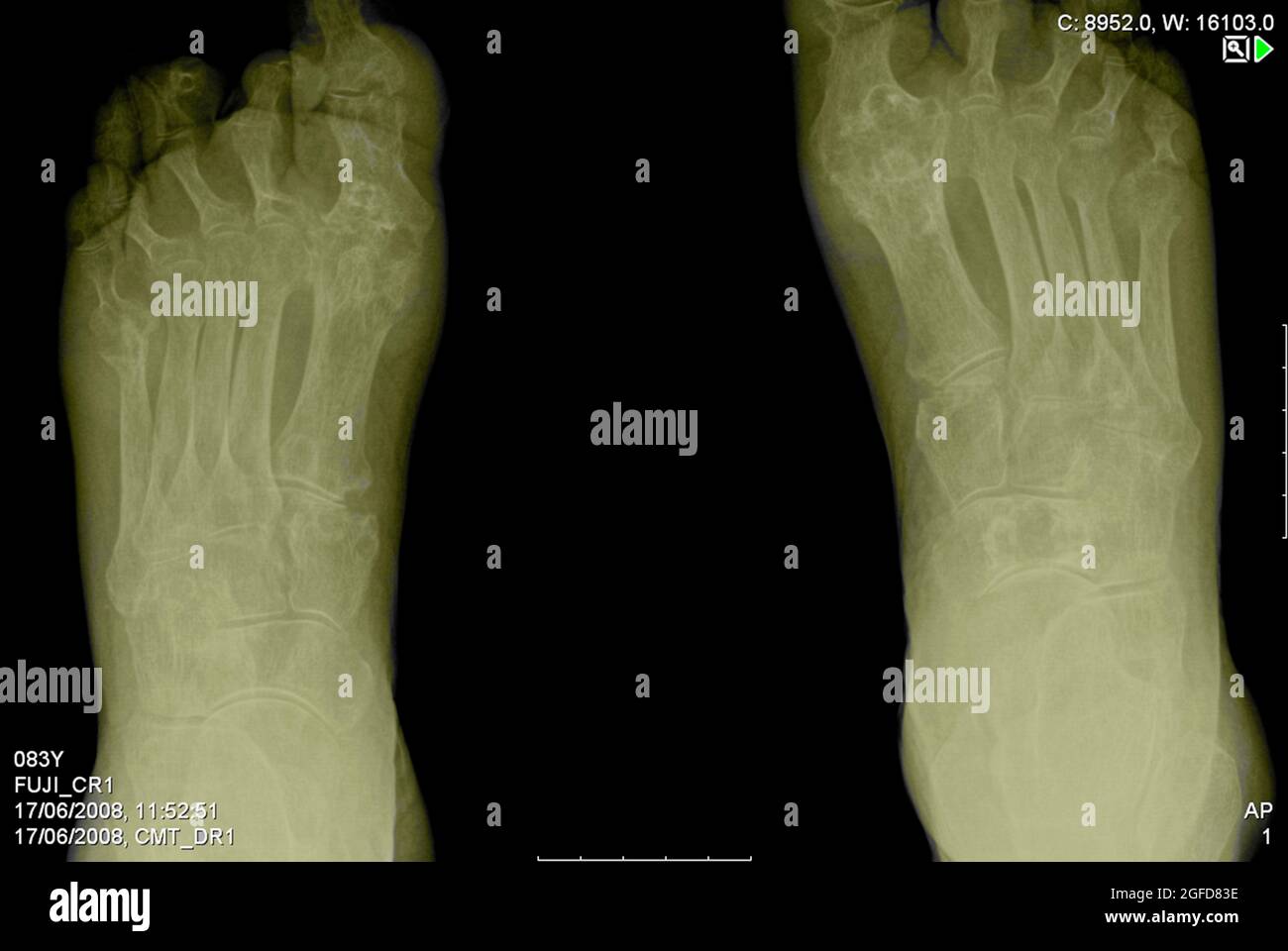 Radiografia dei piedi di un paziente di sesso maschile di 83 anni affetto da artrite reumatoide (RA) Foto Stock