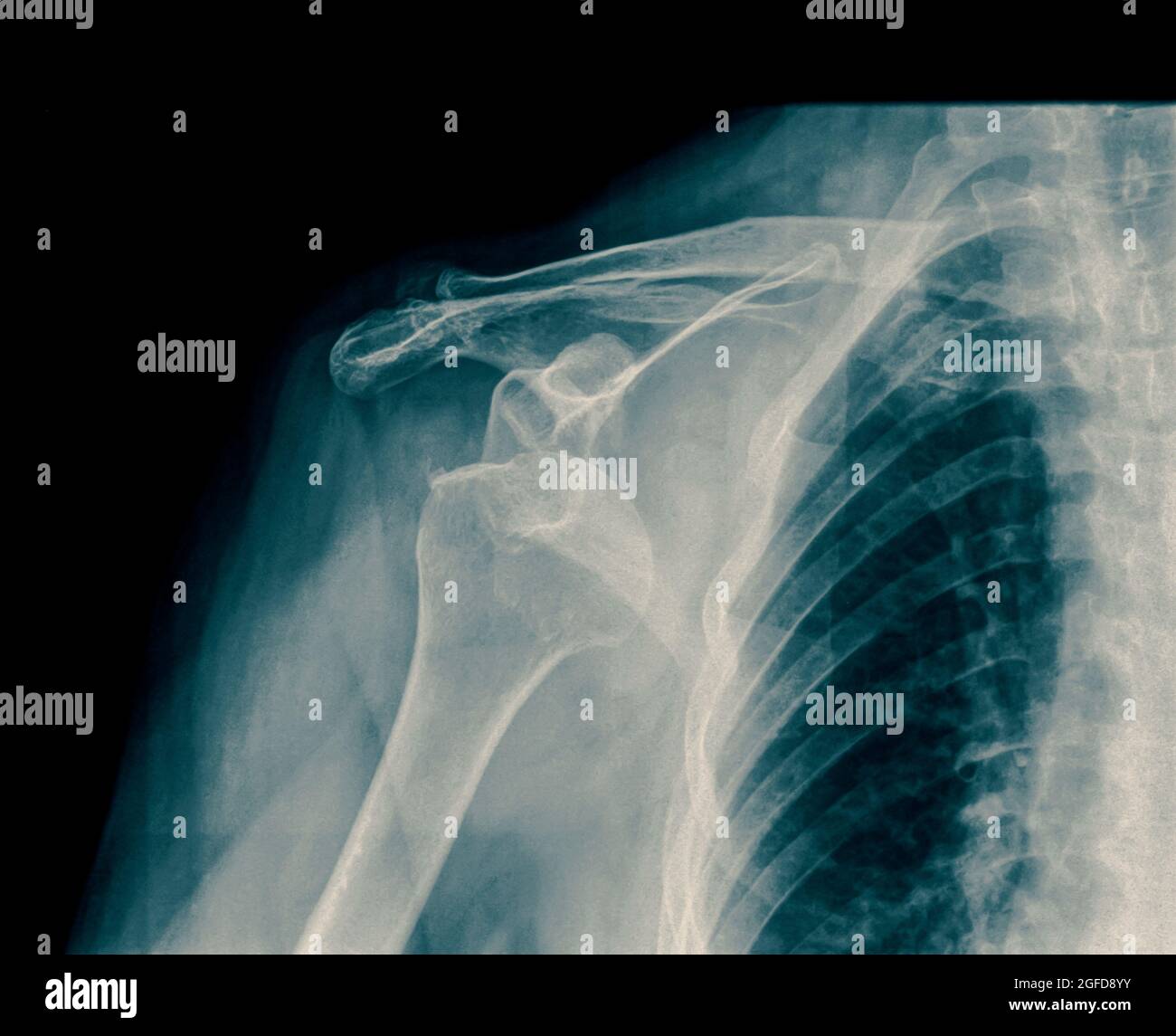 X-ray dislocato spalla su una femmina di 75 anni Foto Stock