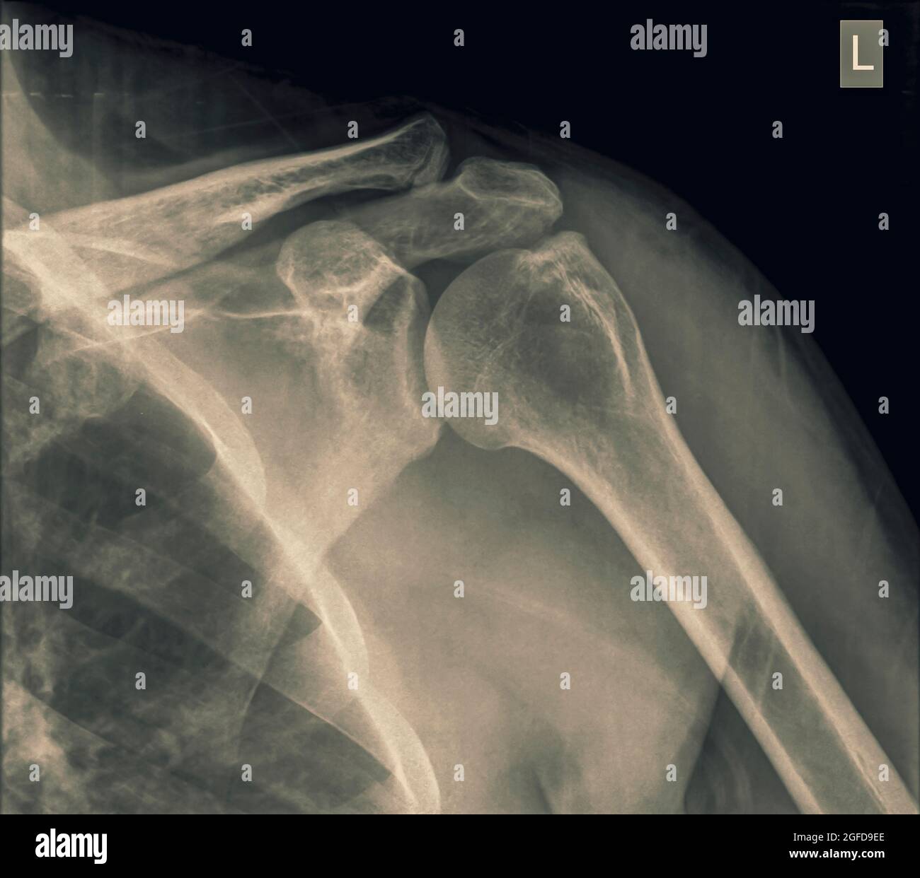 Spalla x-ray di 40 anno vecchio paziente di sesso maschile con una clavicola fratturata vista frontale Foto Stock