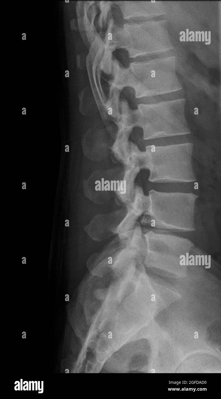 Vista laterale radiologica della colonna lombare umana Foto Stock