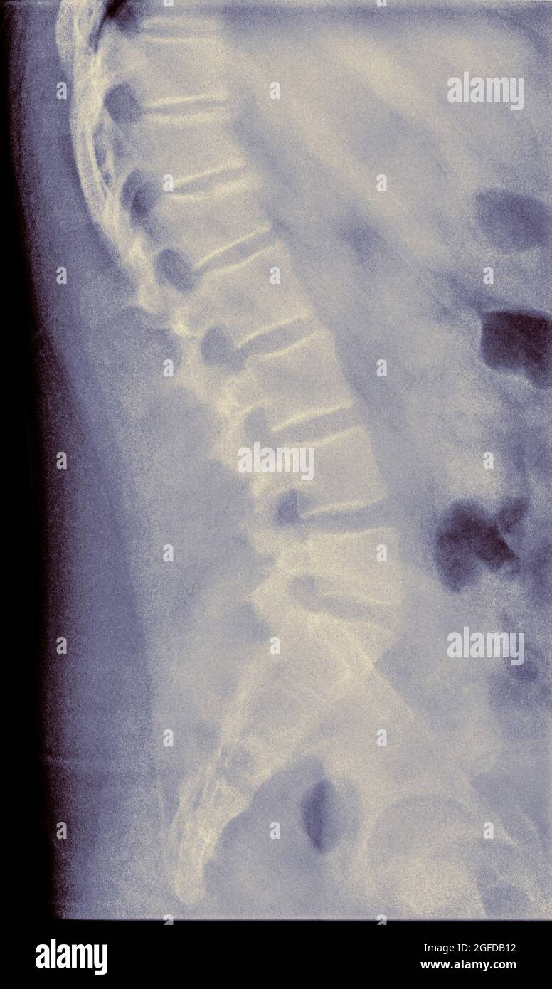 Radiografia della colonna lombare umana di un paziente maschio di 14 anni con frattura da compressione della vista laterale della vertebra L2 Foto Stock