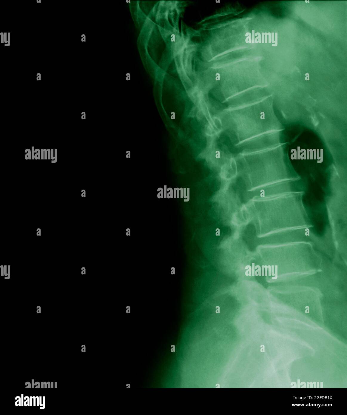 Vista laterale radiologica della colonna lombare umana paziente di 77 anni Foto Stock