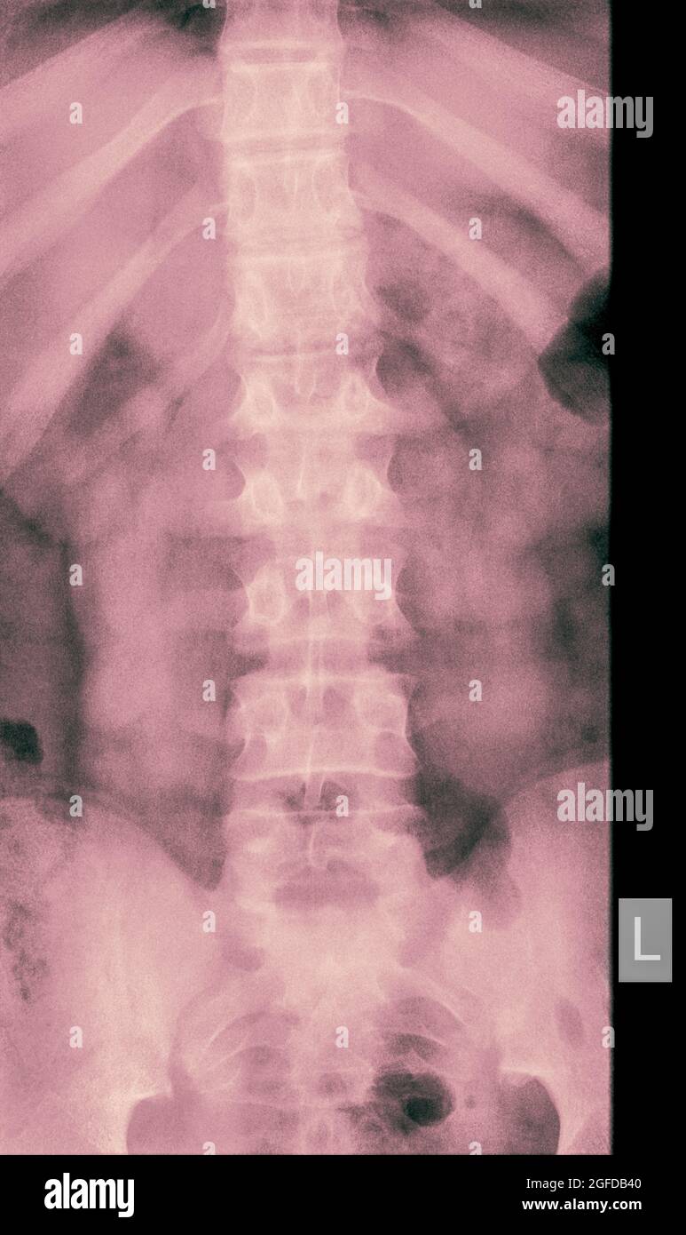 Radiografia della colonna lombare umana di un paziente maschio di 14 anni con frattura da compressione della vertebra L2 Vista frontale Foto Stock