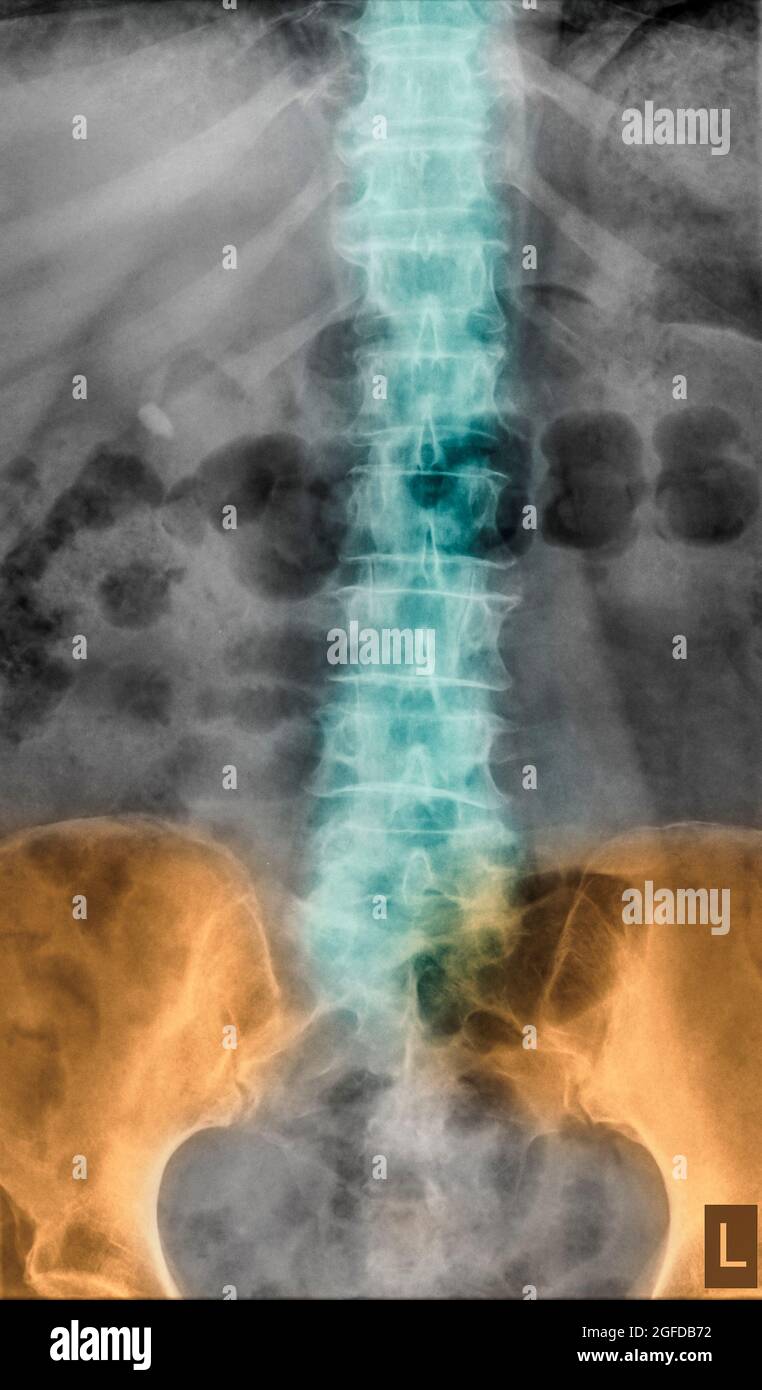 Vista frontale radiologica della colonna lombare umana paziente di 77 anni Foto Stock