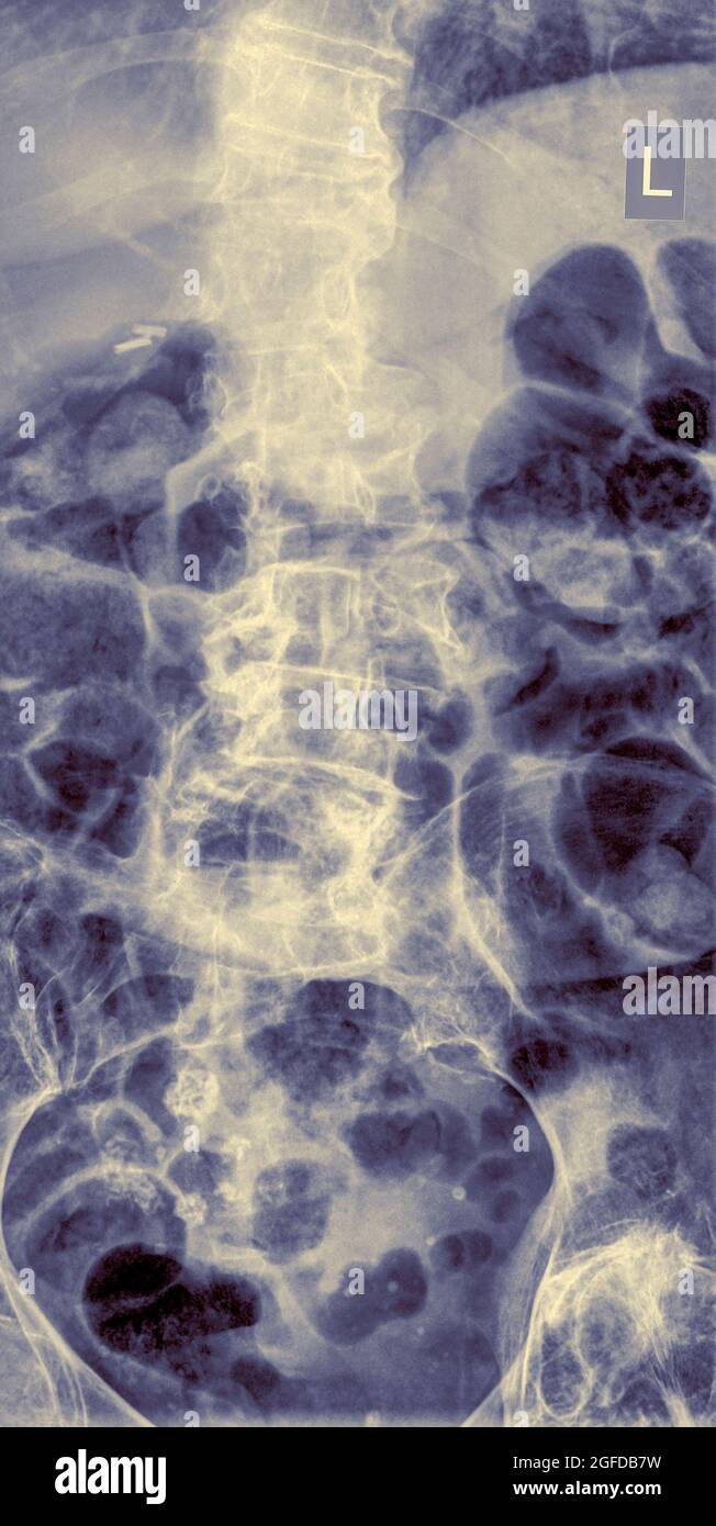 Dolore lombare. Vista frontale colonna lombare umana X-Ray femmina 75 anni Foto Stock