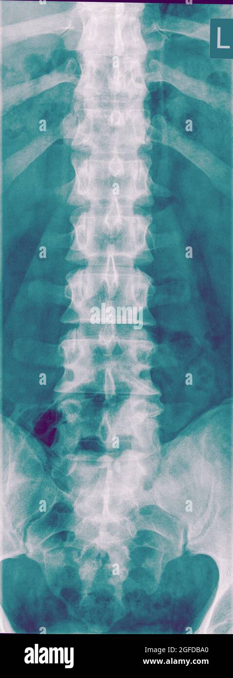 Vista frontale radiologica della colonna lombare umana Foto Stock
