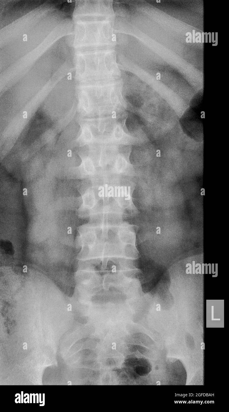 Radiografia della colonna lombare umana di un paziente maschio di 14 anni con frattura da compressione della vertebra L2 Vista frontale Foto Stock