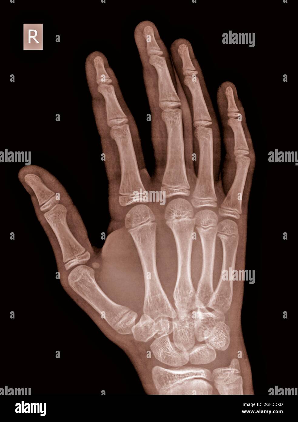 raggi x della mano destra di un maschio di 14 anni con una frattura nell'osso metacarpico numero 3 Foto Stock