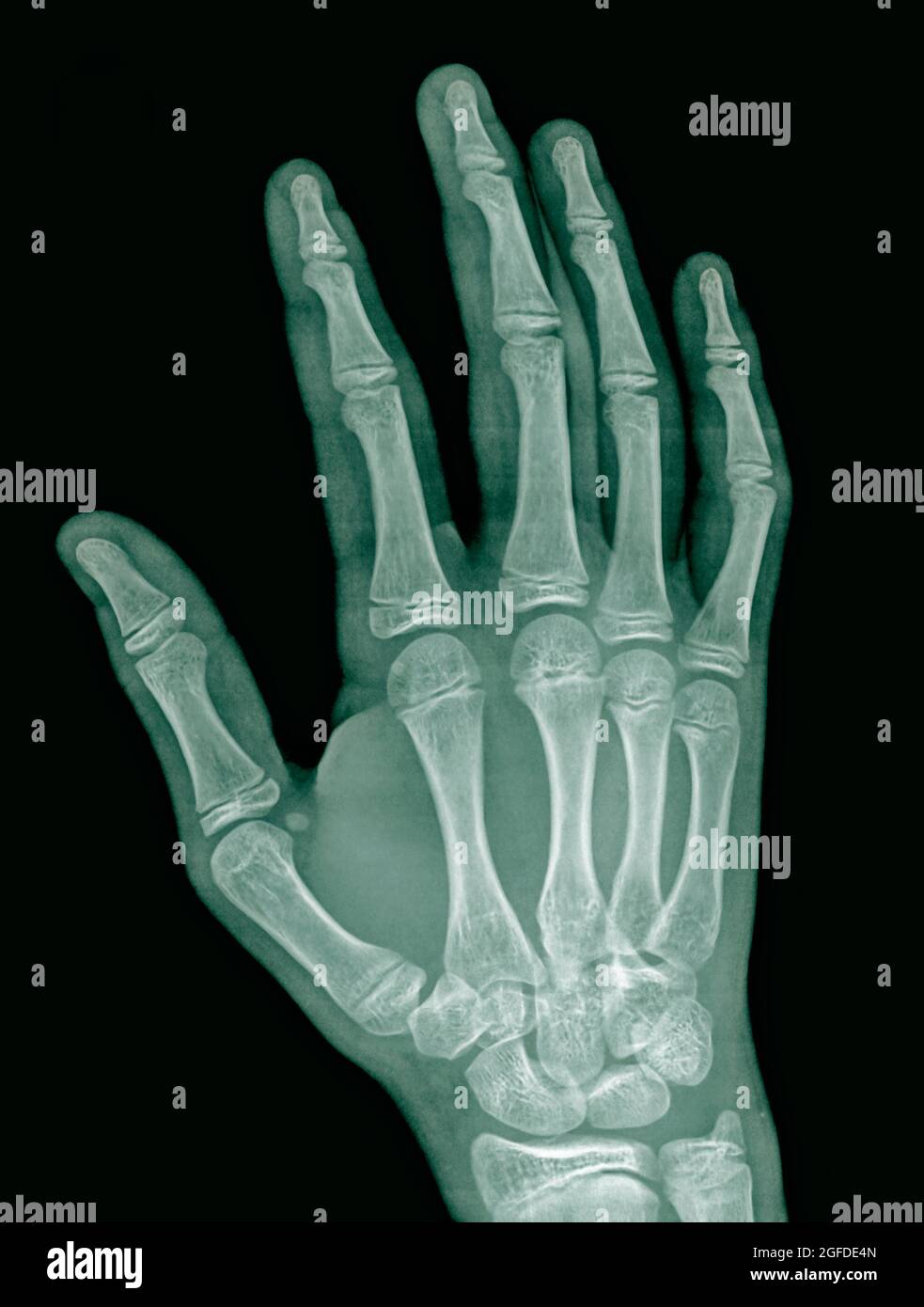 raggi x della mano destra di un maschio di 14 anni con una frattura nell'osso metacarpico numero 3 Foto Stock