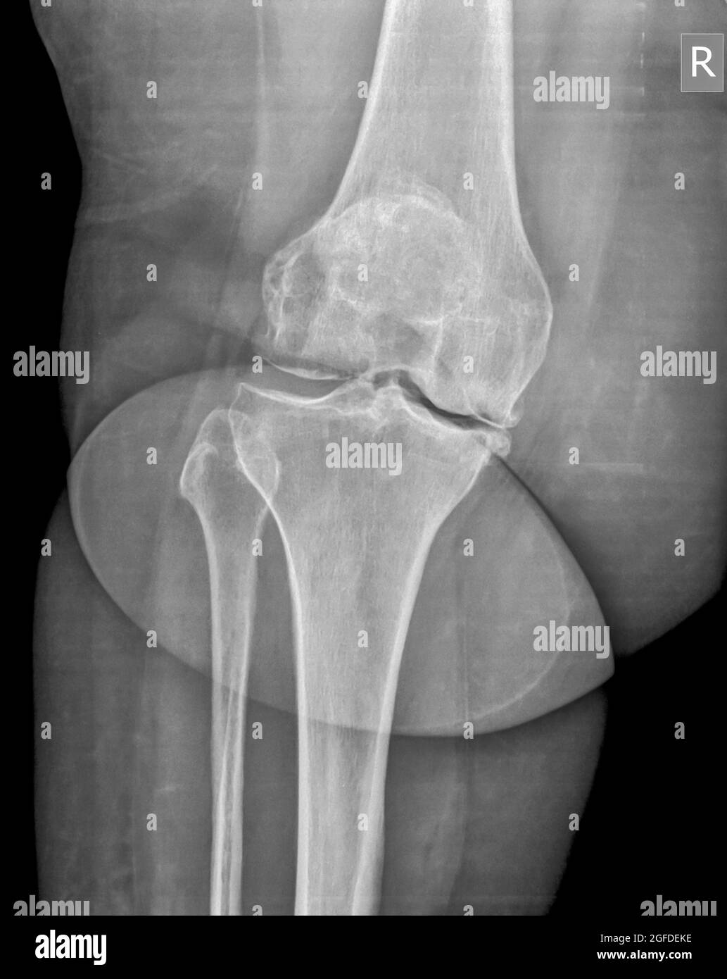 raggi x del ginocchio destro di un maschio di 65 anni Foto Stock