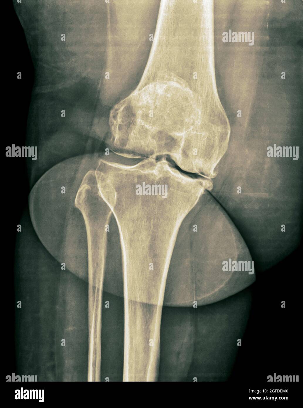 raggi x del ginocchio destro di un maschio di 65 anni Foto Stock