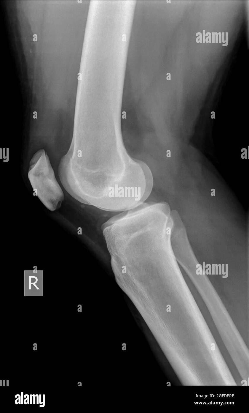 Ginocchio con rotula fratturata. Radiografia di una vista laterale di un paziente di sesso maschile di 27 anni Foto Stock