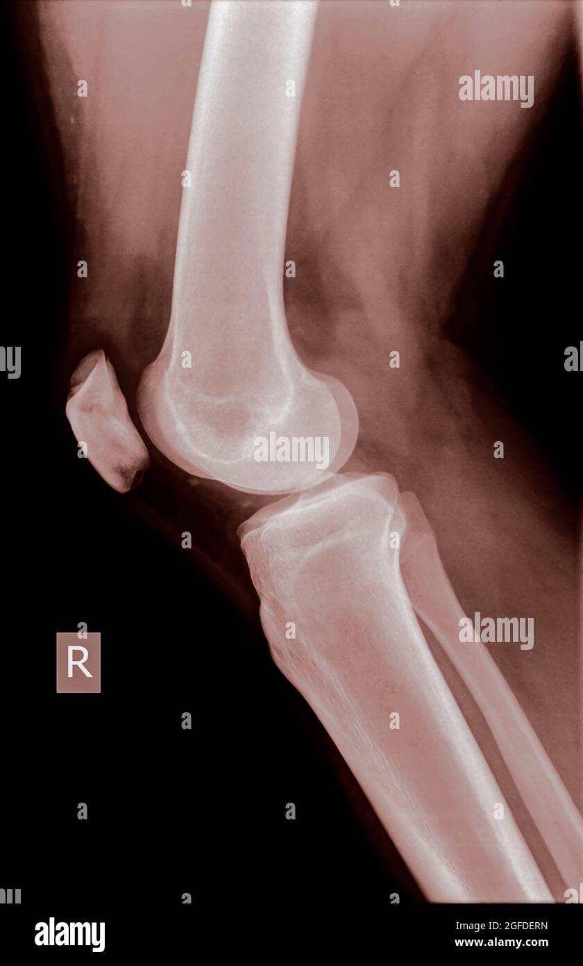 Ginocchio con rotula fratturata. Radiografia di una vista laterale di un paziente di sesso maschile di 27 anni Foto Stock
