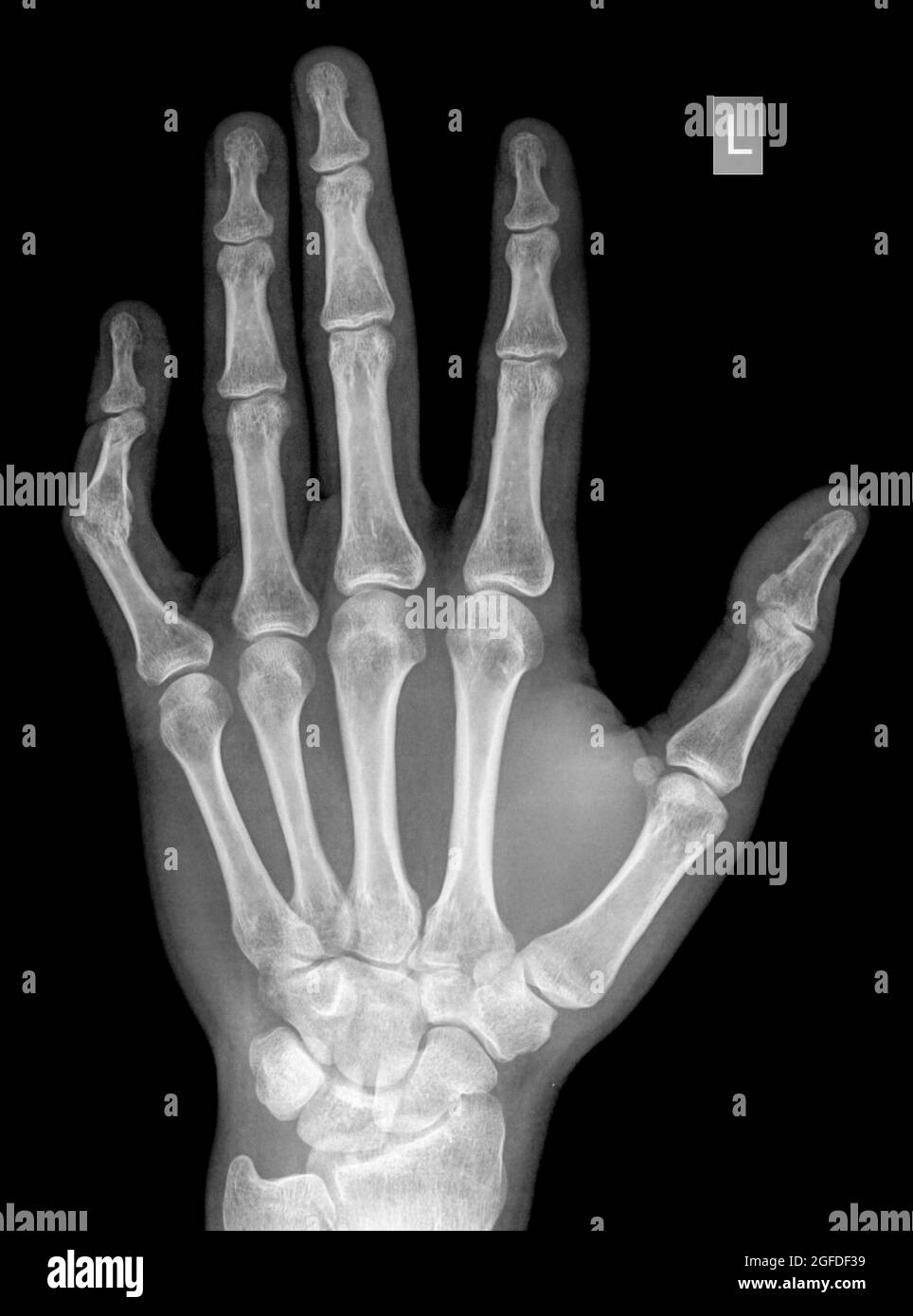 raggi x di polso, mano e dita di un paziente di 34 anni di sesso maschile con un pollice sinistro disposizionato a causa di contusione Foto Stock