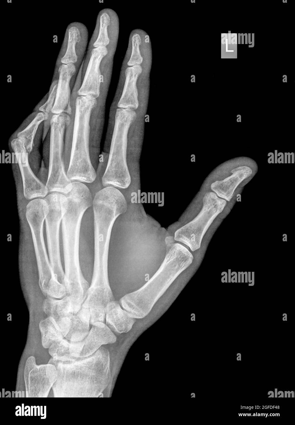 raggi x di polso, mano e dita di un paziente di 34 anni di sesso maschile con un pollice sinistro disposizionato a causa di contusione Foto Stock
