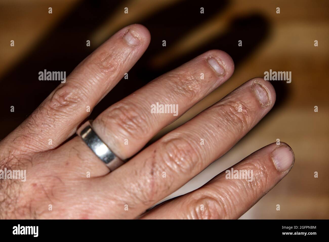 Primo piano delle dita di un maschio con chiodi rotti che indossano un  anello Foto stock - Alamy